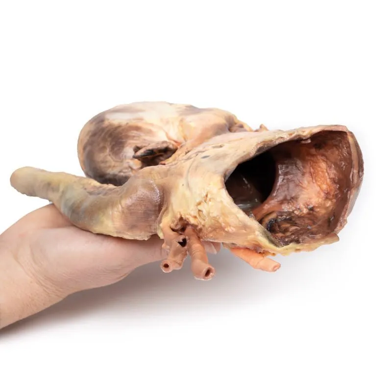 3D Printed Acute Syphilitic Aneurysm