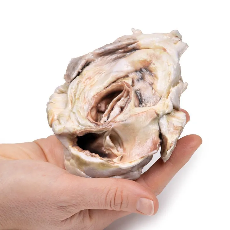 3D Printed Calcified Aortic Valvular Stenosis Biscuspid Valve