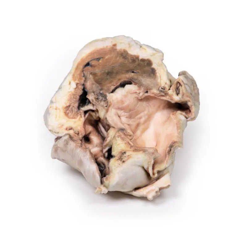 3D Printed Calcified Aortic Valvular Stenosis Biscuspid Valve