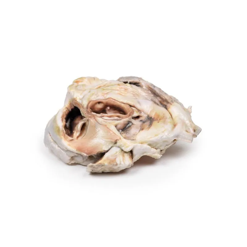 3D Printed Calcified Aortic Valvular Stenosis Biscuspid Valve