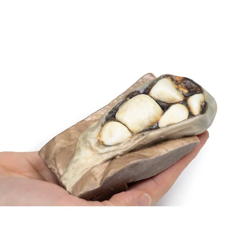 3D Printed Cholelithiasis (Gallstones)