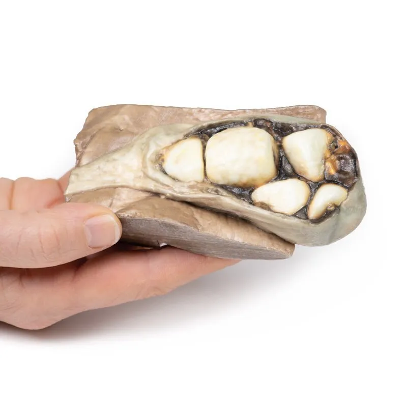 3D Printed Cholelithiasis (Gallstones)