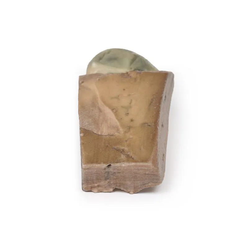 3D Printed Cholelithiasis (Gallstones)