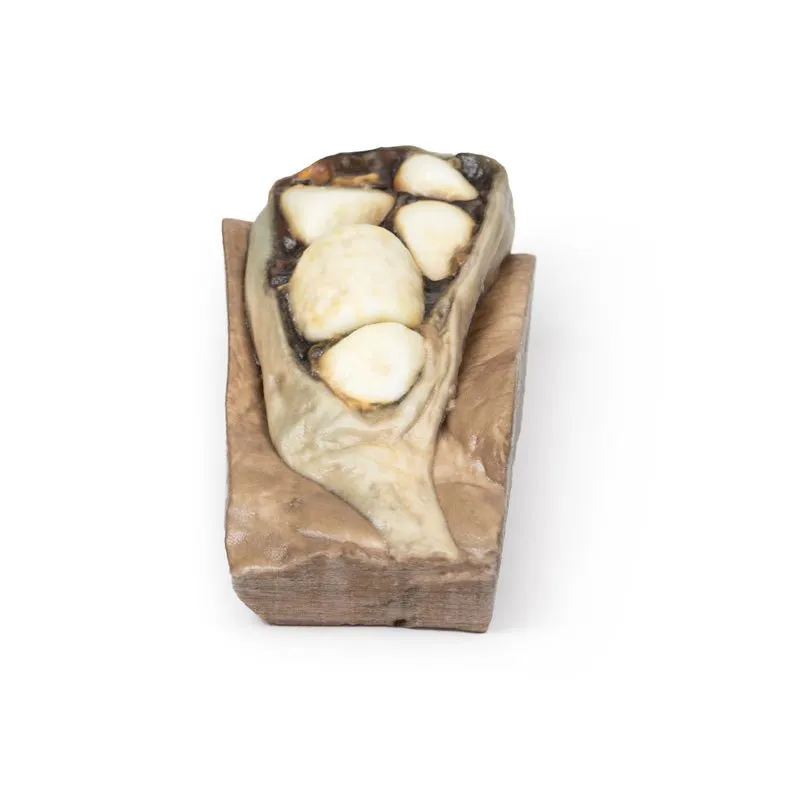 3D Printed Cholelithiasis (Gallstones)