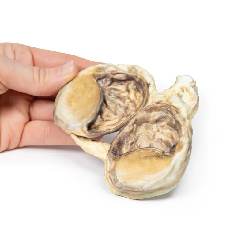 3D Printed Chronic Hydrocoele