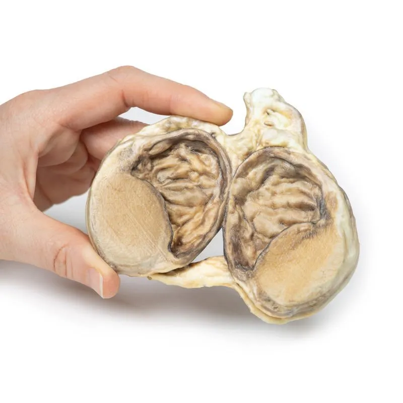 3D Printed Chronic Hydrocoele