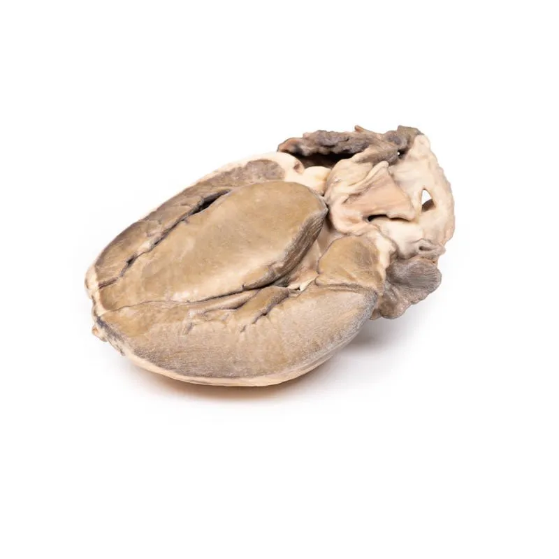 3D Printed Hypertrophic Subaortic Stenosis