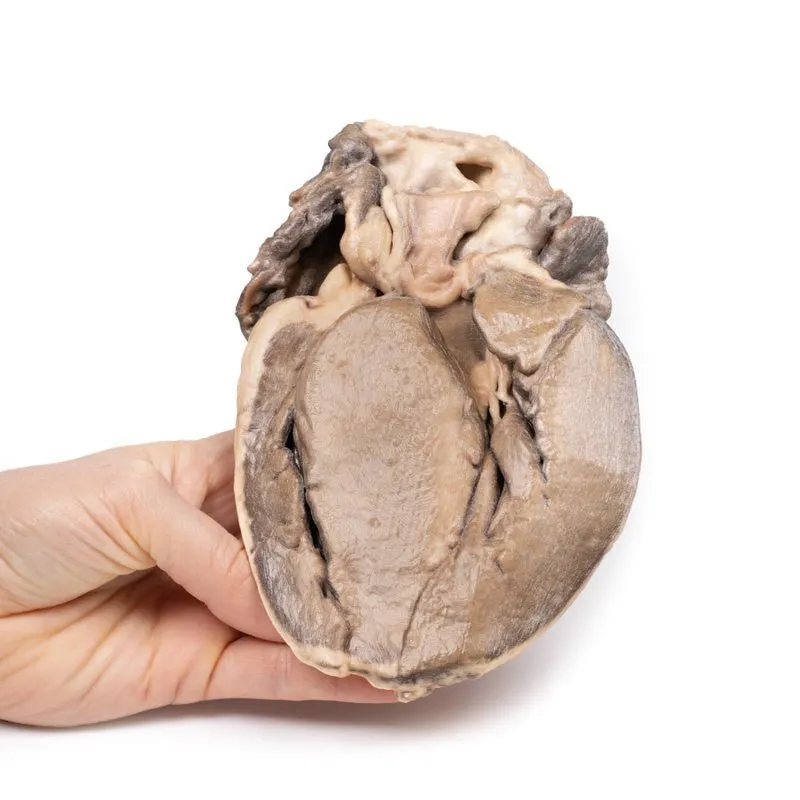 3D Printed Hypertrophic Subaortic Stenosis