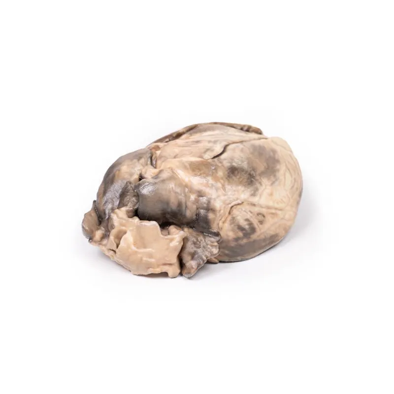 3D Printed Hypertrophic Subaortic Stenosis