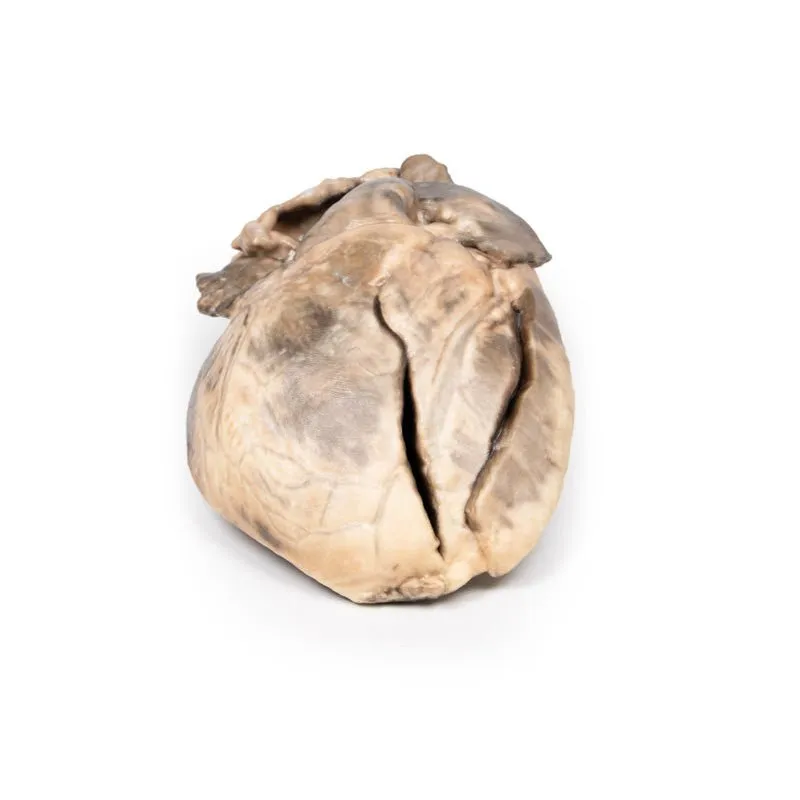 3D Printed Hypertrophic Subaortic Stenosis