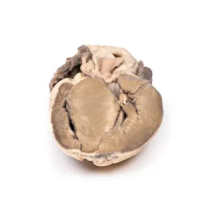 3D Printed Hypertrophic Subaortic Stenosis