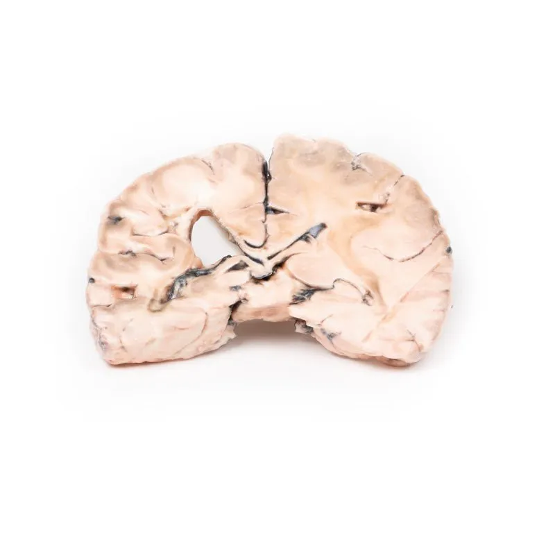 3D Printed Left Cerebral Infarct