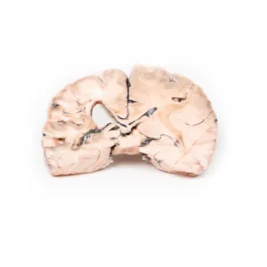 3D Printed Left Cerebral Infarct