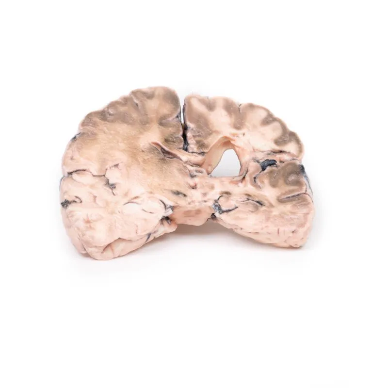 3D Printed Left Cerebral Infarct