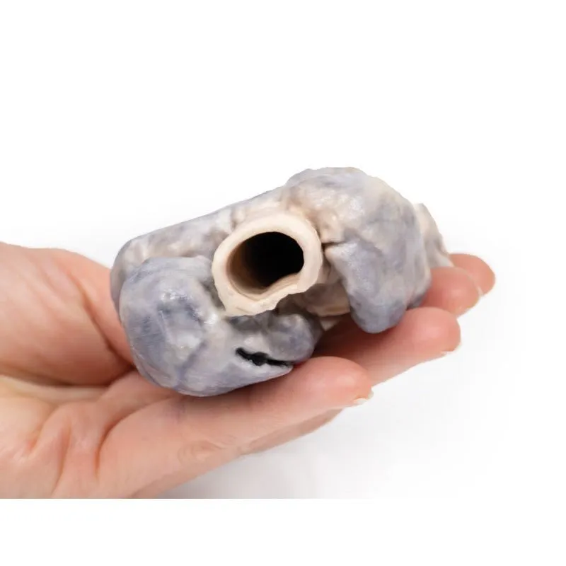 3D Printed Retrosternal Goiter