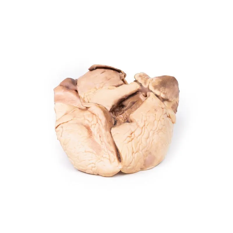 3D Printed Rheumatic Endocarditis